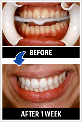 Pin on Natural teeth whitening