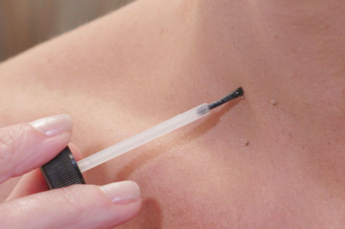 close up of Brush applicator on skin tag 