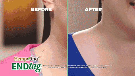 Animation of before and afters of skin tags on skin, and after Hempvana End Tag with no skin tags
